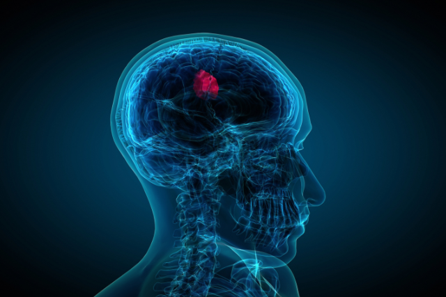 Brain Tumor Surgery
